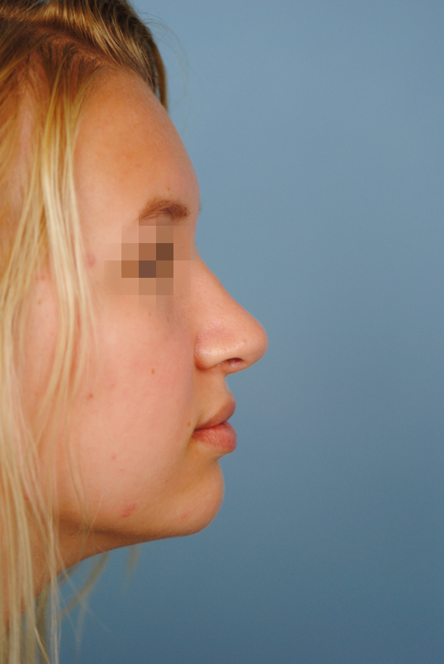 Rhinoplasty Before and After | Thomas Funcik MD