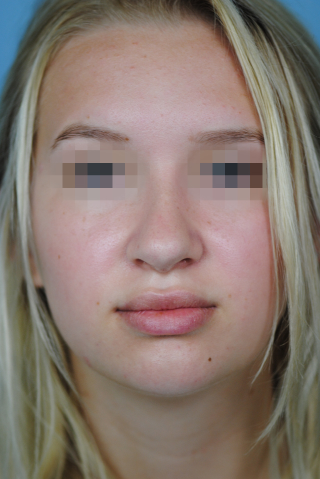 Rhinoplasty Before and After | Thomas Funcik MD