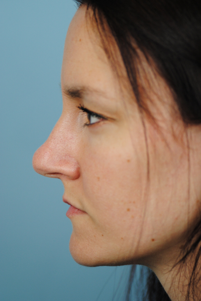 Rhinoplasty Before and After | Thomas Funcik MD