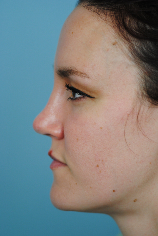 Rhinoplasty Before and After | Thomas Funcik MD