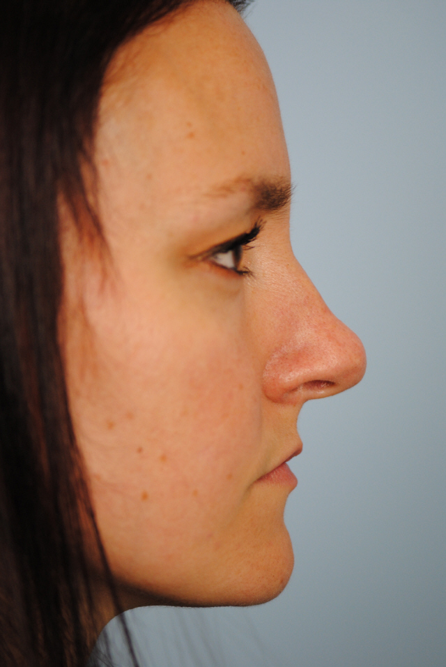 Rhinoplasty Before and After | Thomas Funcik MD