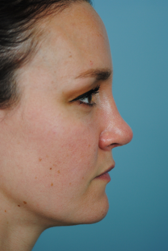 Rhinoplasty Before and After | Thomas Funcik MD