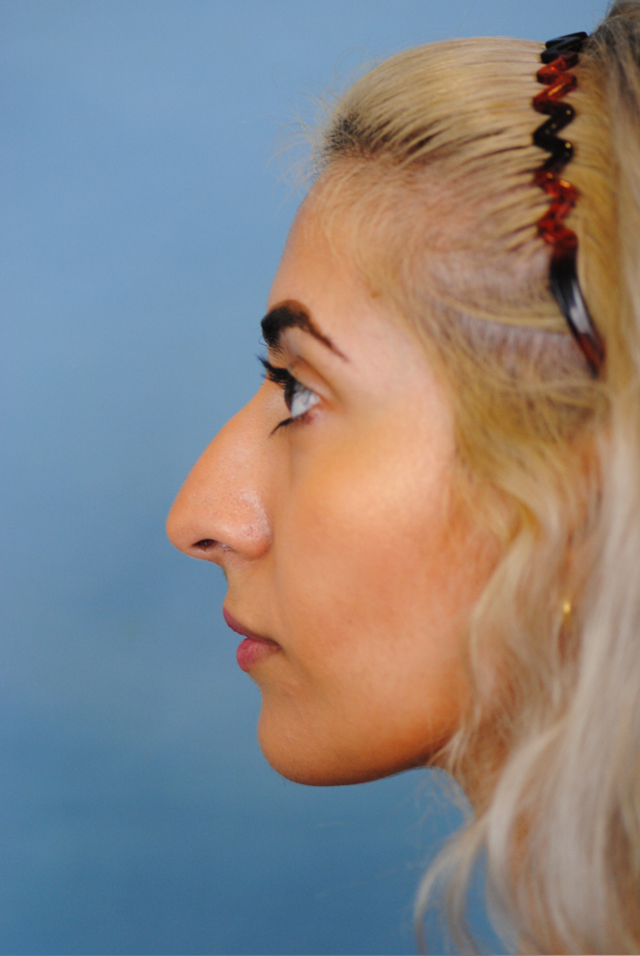 Rhinoplasty Before and After | Thomas Funcik MD