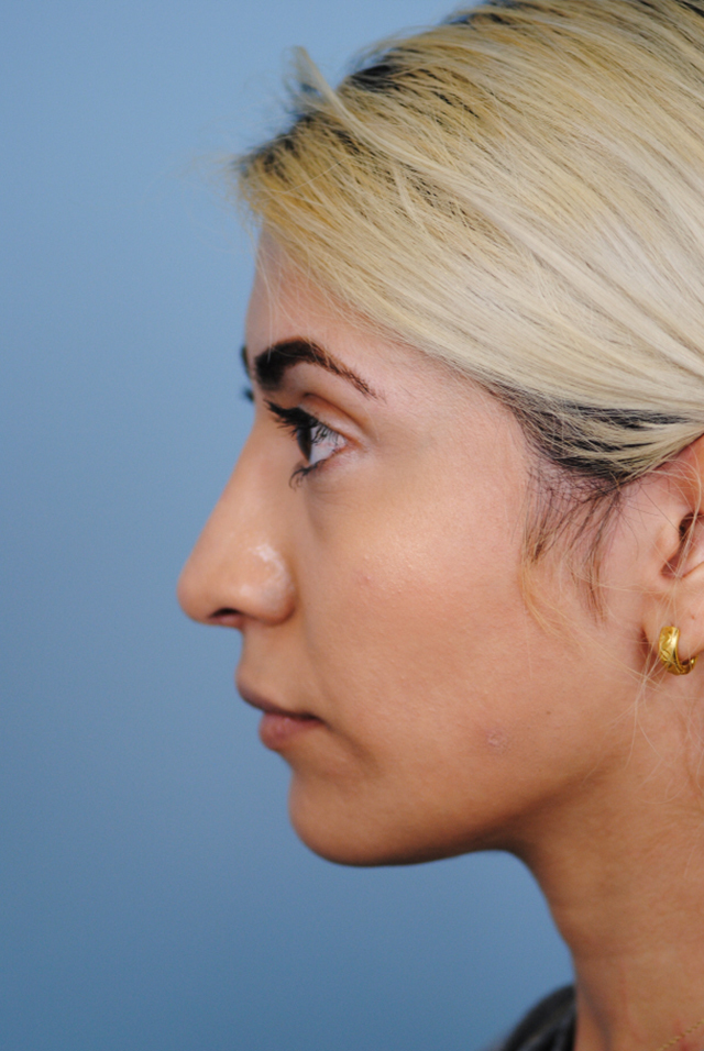 Rhinoplasty Before and After | Thomas Funcik MD