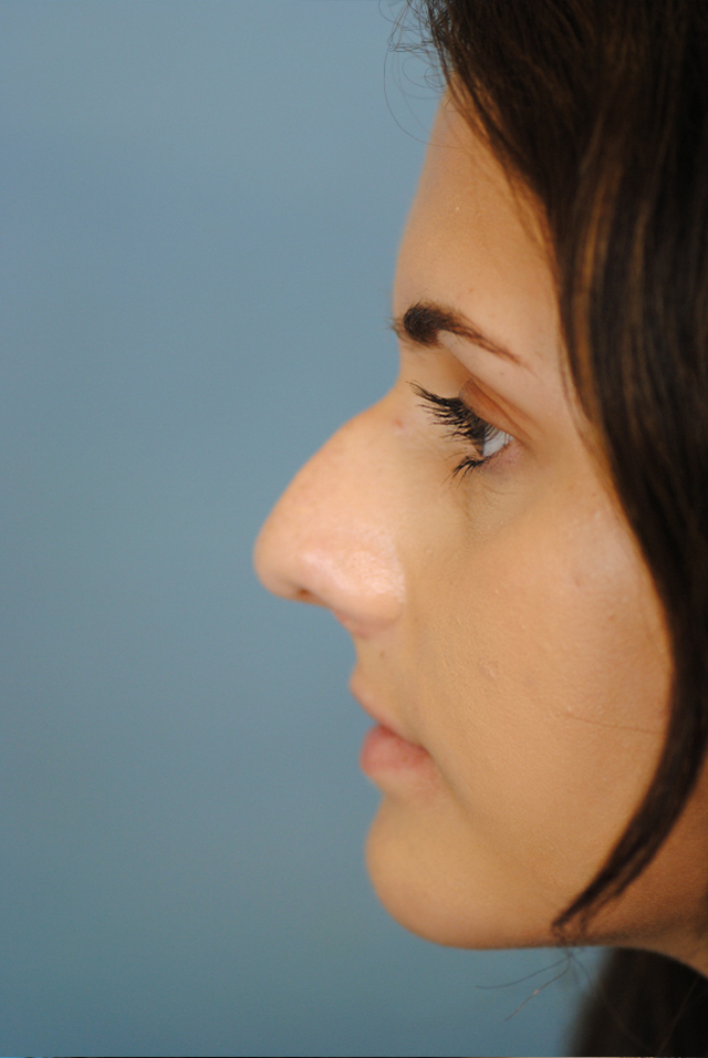 Rhinoplasty Before and After | Thomas Funcik MD