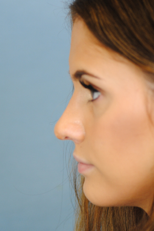 Rhinoplasty Before and After | Thomas Funcik MD