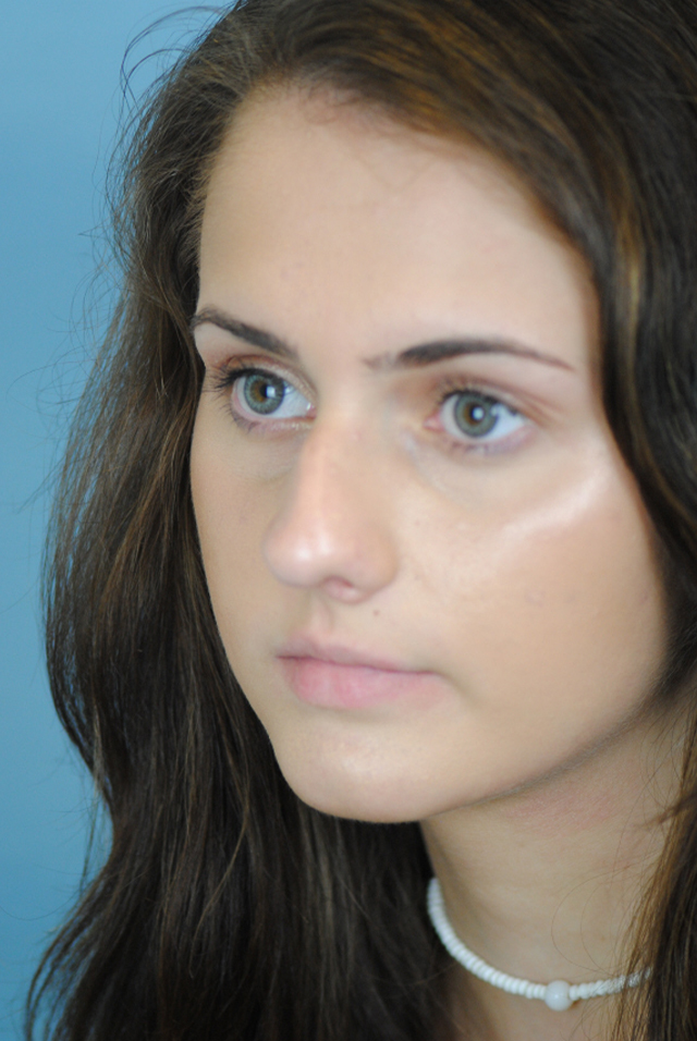 Rhinoplasty Before and After | Thomas Funcik MD