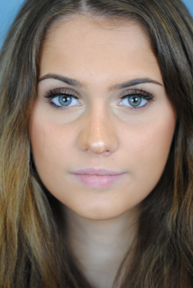 Rhinoplasty Before and After | Thomas Funcik MD