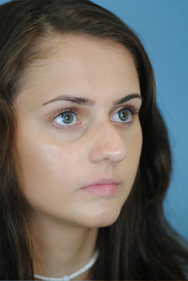 Rhinoplasty Before and After | Thomas Funcik MD