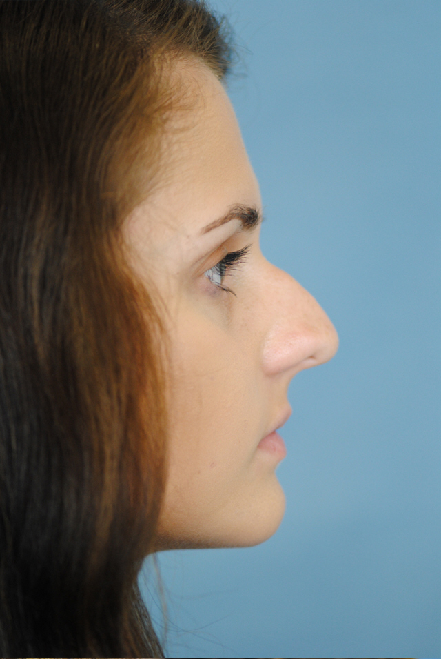 Rhinoplasty Before and After | Thomas Funcik MD