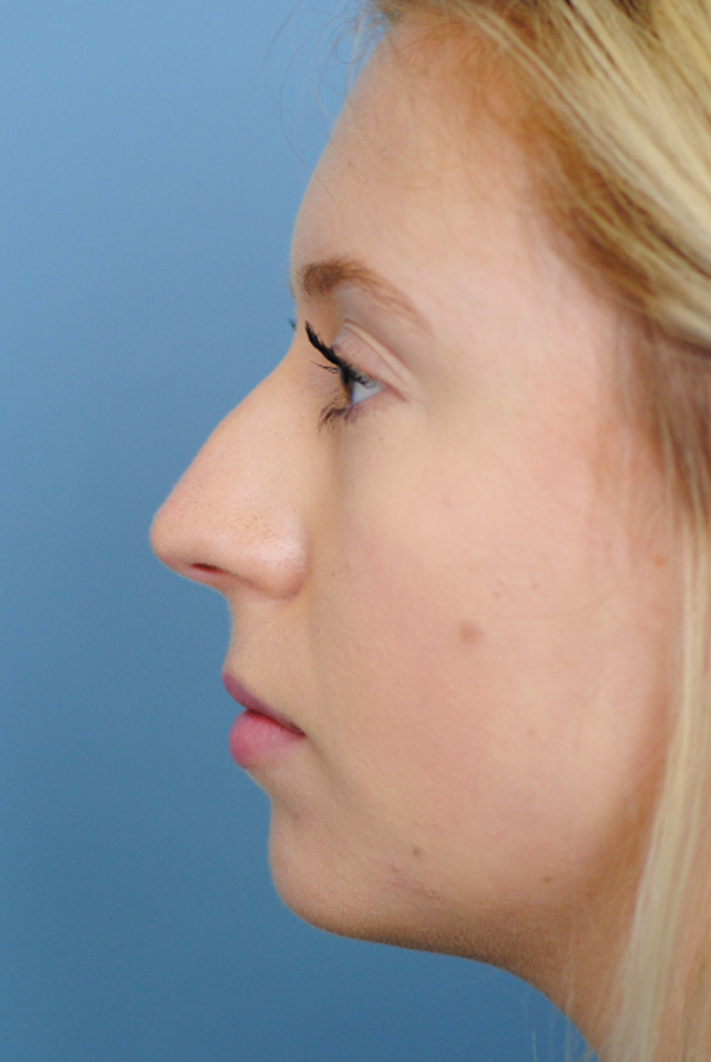 Rhinoplasty Before and After | Thomas Funcik MD