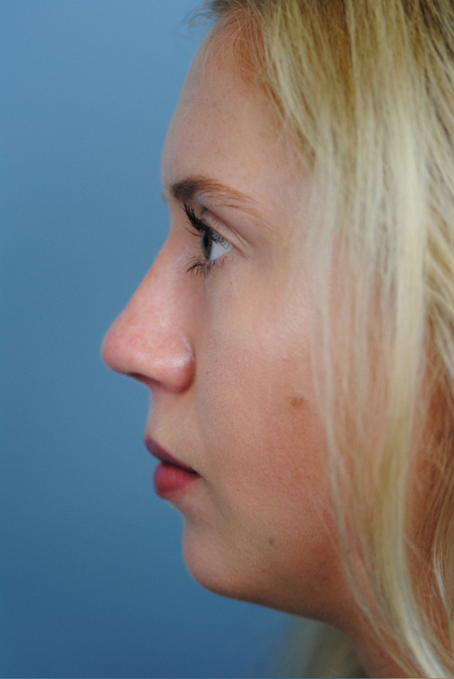 Rhinoplasty Before and After | Thomas Funcik MD