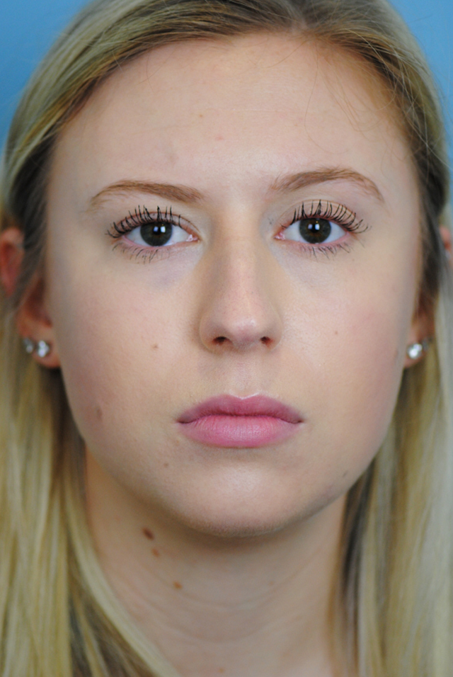 Rhinoplasty Before and After | Thomas Funcik MD