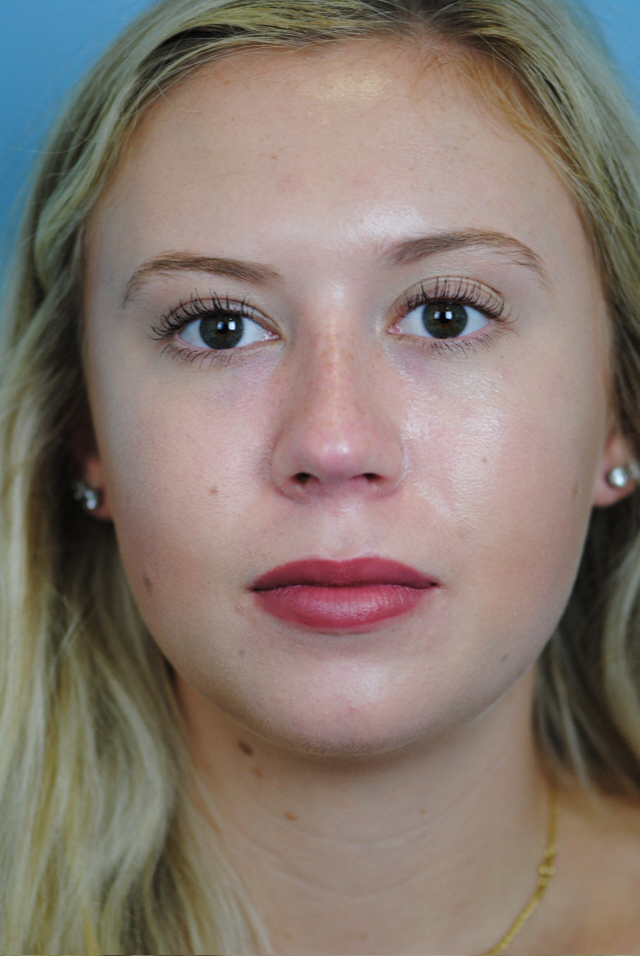 Rhinoplasty Before and After | Thomas Funcik MD