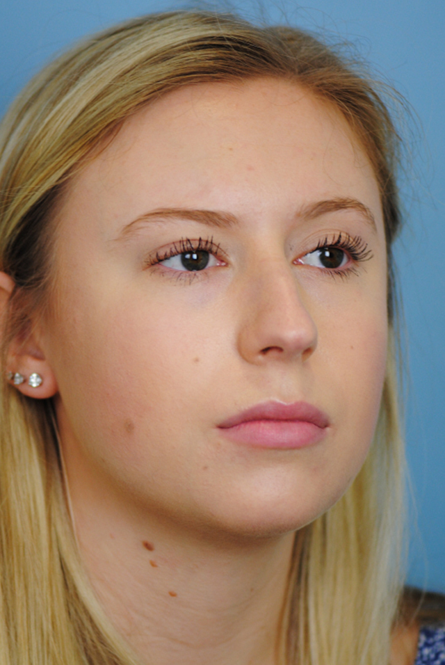 Rhinoplasty Before and After | Thomas Funcik MD