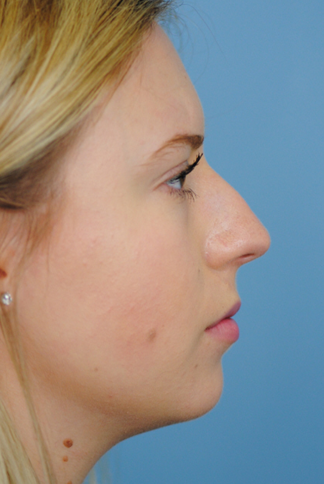 Rhinoplasty Before and After | Thomas Funcik MD