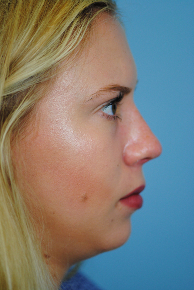 Rhinoplasty Before and After | Thomas Funcik MD