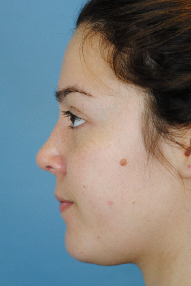 Rhinoplasty Before and After | Thomas Funcik MD