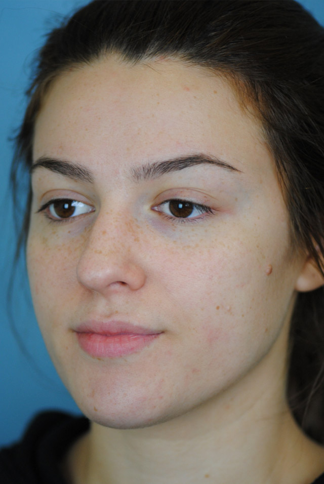 Rhinoplasty Before and After | Thomas Funcik MD