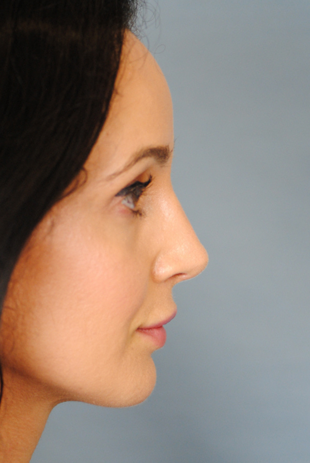 Rhinoplasty Before and After | Thomas Funcik MD