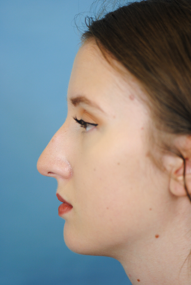 Rhinoplasty Before and After | Thomas Funcik MD