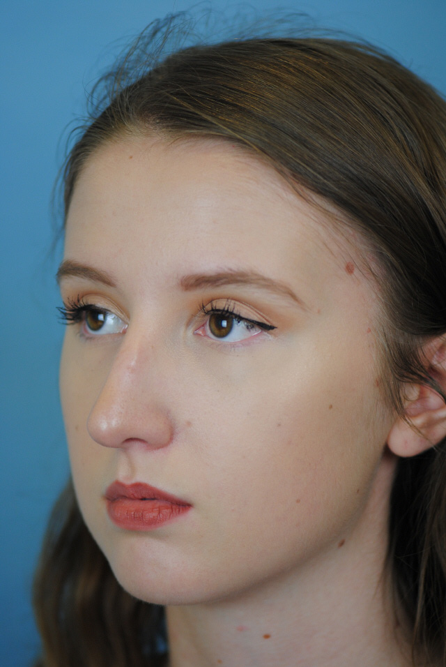 Rhinoplasty Before and After | Thomas Funcik MD