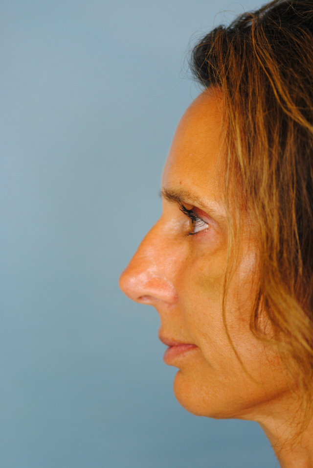 Rhinoplasty Before and After | Thomas Funcik MD