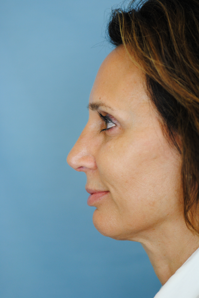 Rhinoplasty Before and After | Thomas Funcik MD