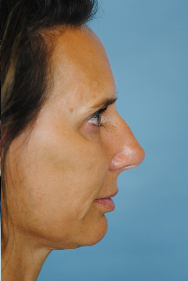 Rhinoplasty Before and After | Thomas Funcik MD