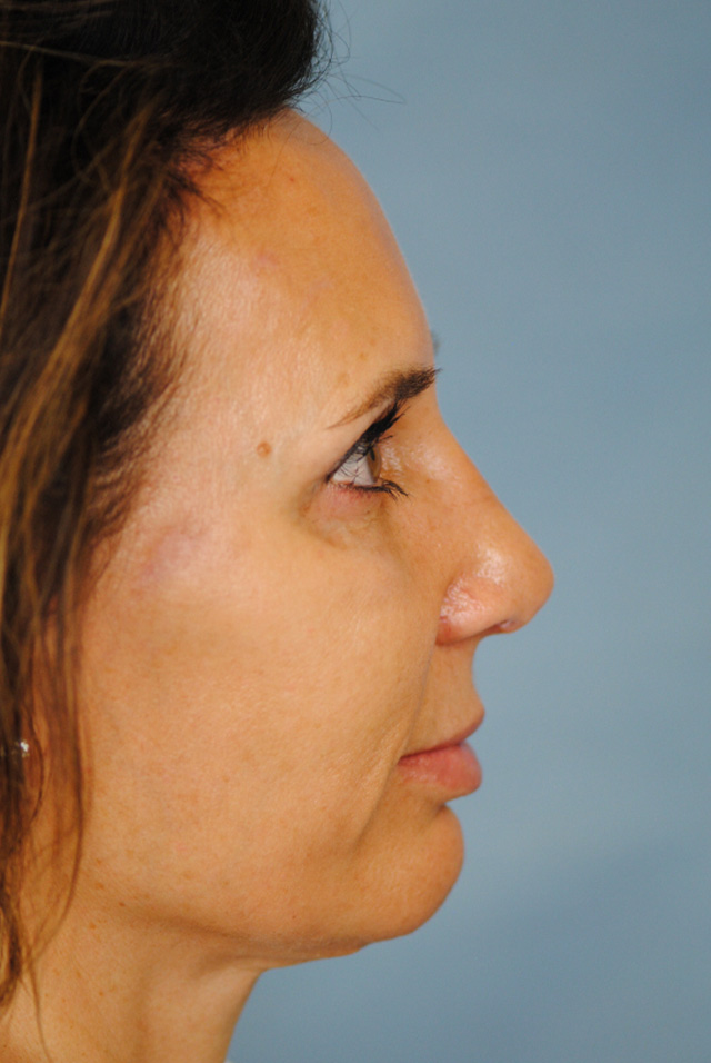 Rhinoplasty Before and After | Thomas Funcik MD