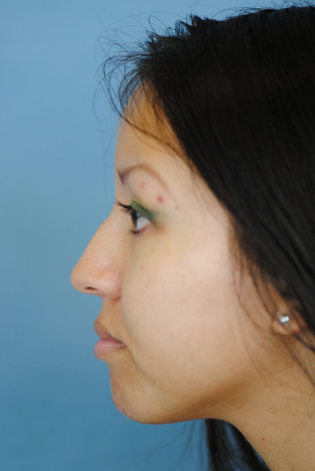 Rhinoplasty Before and After | Thomas Funcik MD