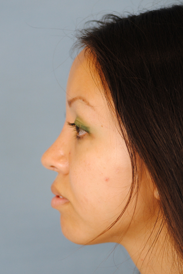 Rhinoplasty Before and After | Thomas Funcik MD