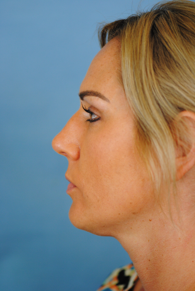 Rhinoplasty Before and After | Thomas Funcik MD