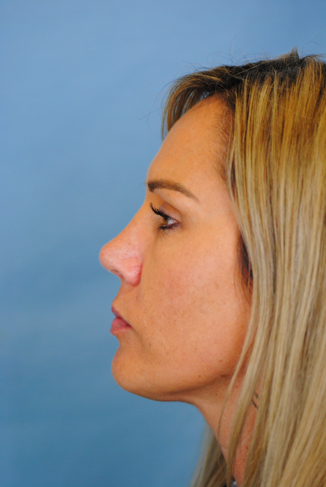 Rhinoplasty Before and After | Thomas Funcik MD