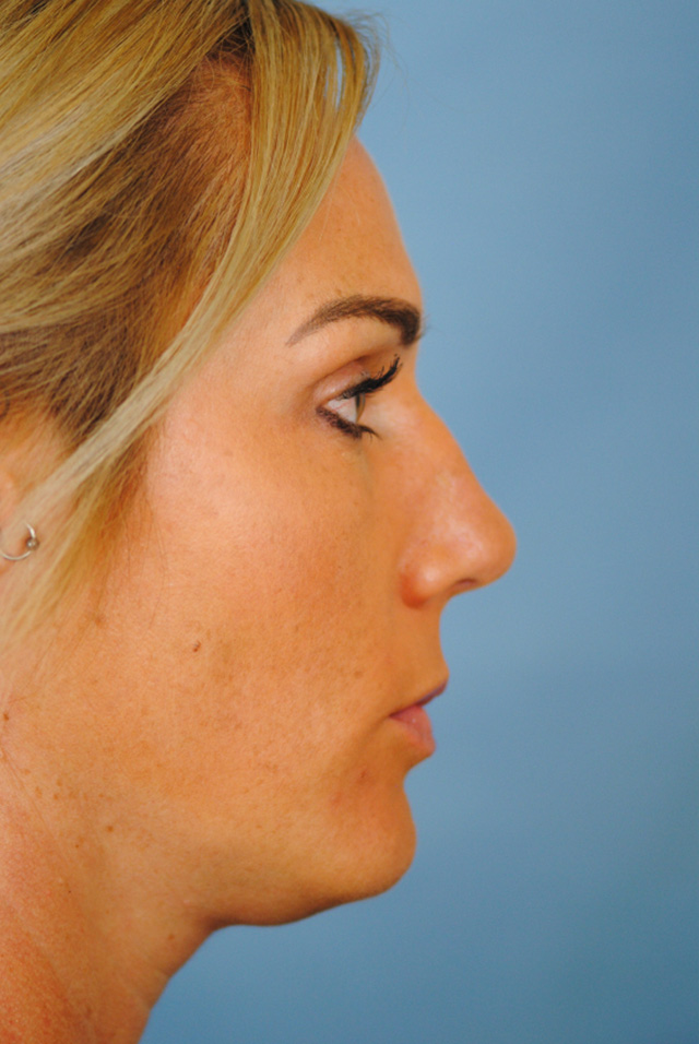 Rhinoplasty Before and After | Thomas Funcik MD