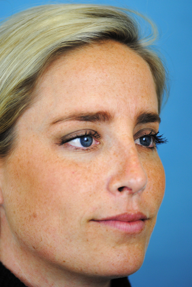 Rhinoplasty Before and After | Thomas Funcik MD