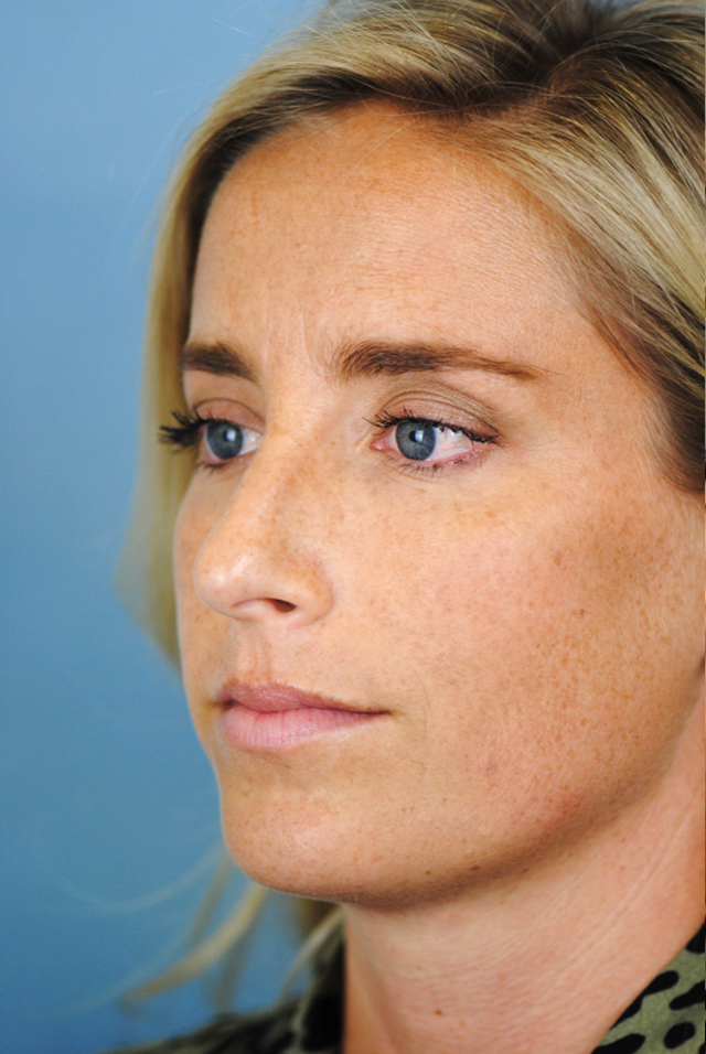 Rhinoplasty Before and After | Thomas Funcik MD