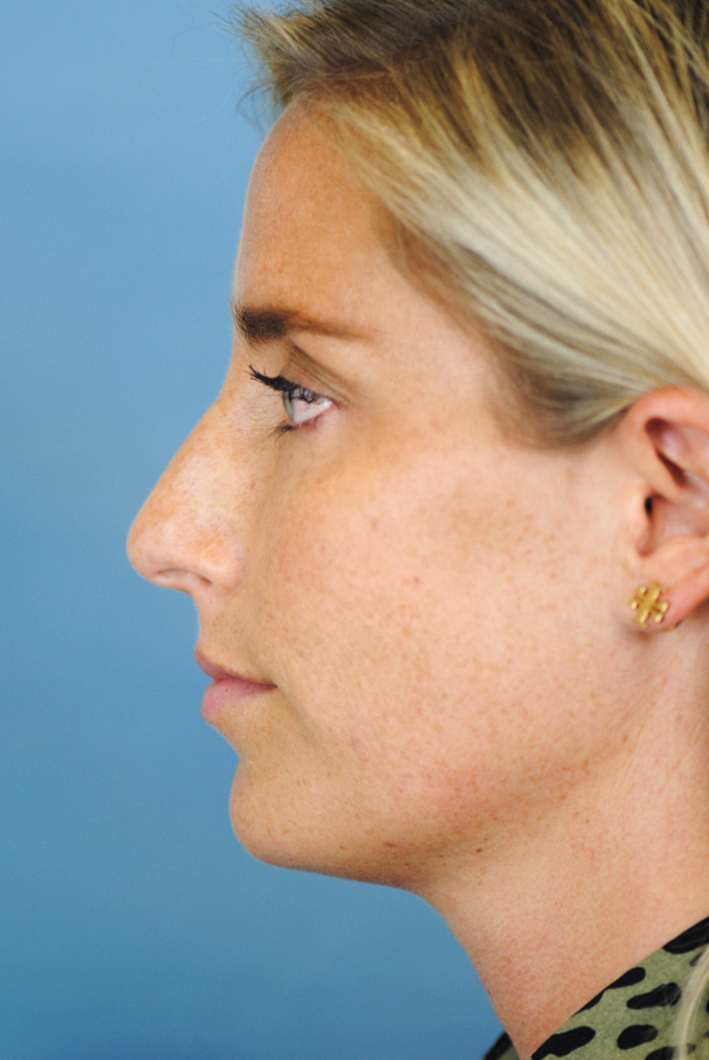 Rhinoplasty Before and After | Thomas Funcik MD