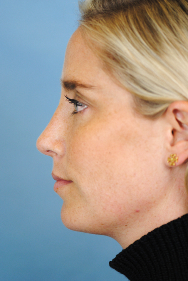 Rhinoplasty Before and After | Thomas Funcik MD