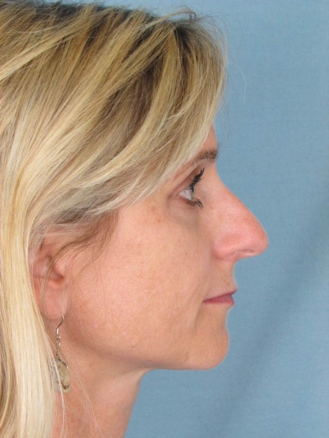 Rhinoplasty Before and After | Thomas Funcik MD