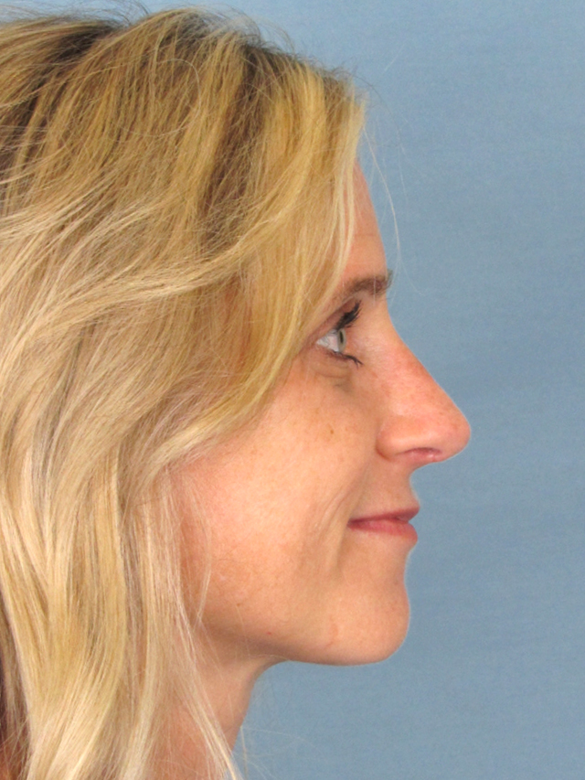 Rhinoplasty Before and After | Thomas Funcik MD