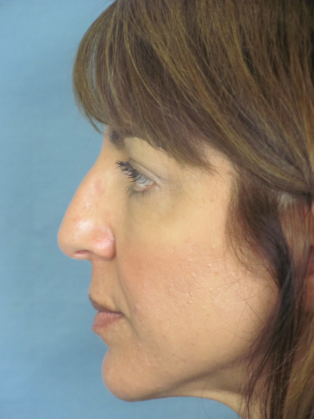 Rhinoplasty Before and After | Thomas Funcik MD