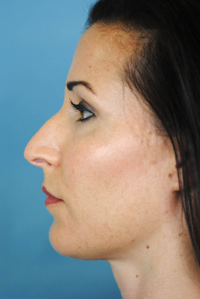 Rhinoplasty Before and After | Thomas Funcik MD