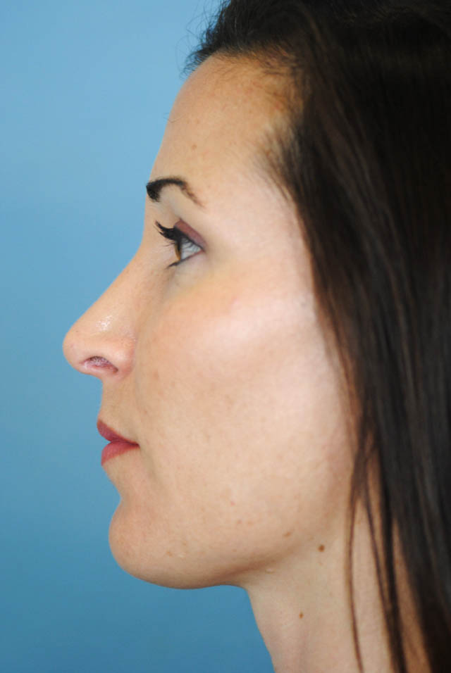 Rhinoplasty Before and After | Thomas Funcik MD