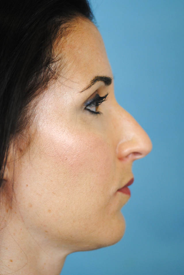 Rhinoplasty Before and After | Thomas Funcik MD