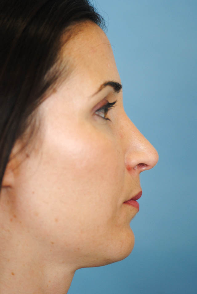 Rhinoplasty Before and After | Thomas Funcik MD