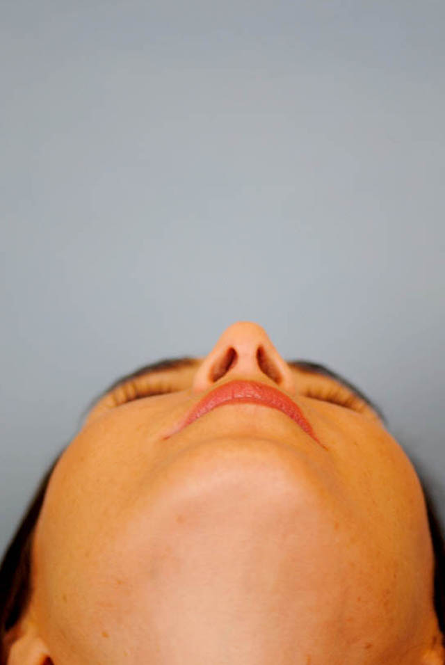 Rhinoplasty Before and After | Thomas Funcik MD