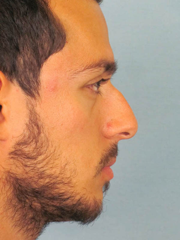 Rhinoplasty Before and After | Thomas Funcik MD