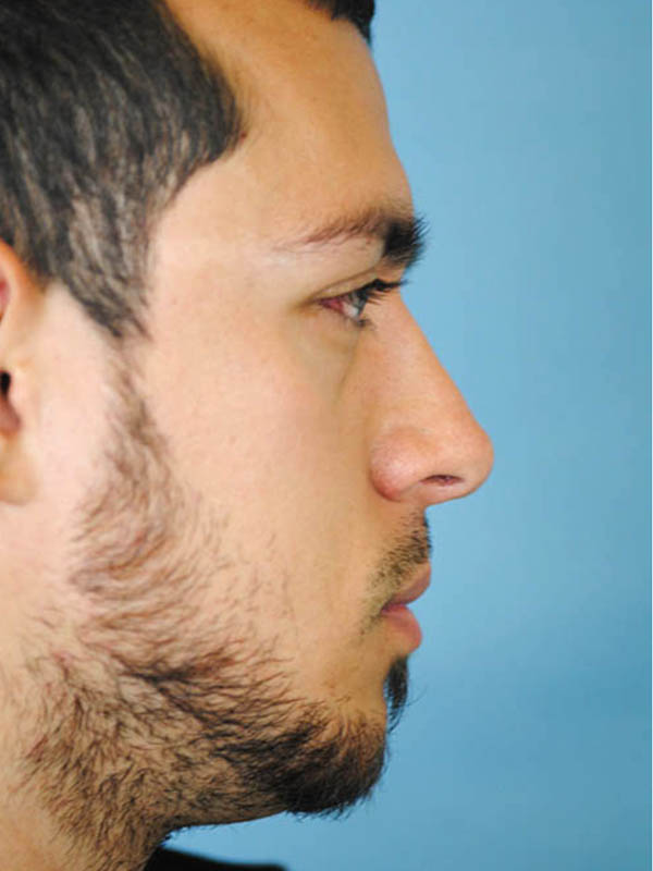 Rhinoplasty Before and After | Thomas Funcik MD