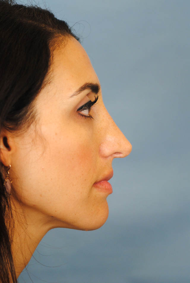 Rhinoplasty Before and After | Thomas Funcik MD